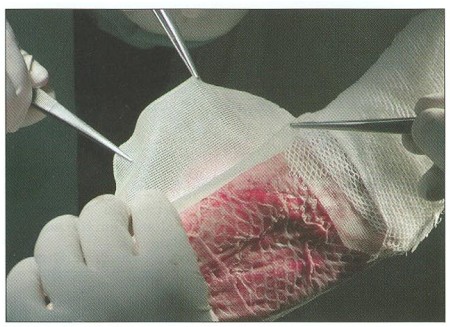 Fig. 7Application of autologous cultured keratinocytes attached to vazeline gauze over ř idely meshed autograft. This procedure is used in extensive burns and brings short healing time and better cosmetic effect