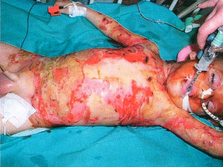 Fig. 1Burned child, 25% TBSA, before excision