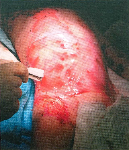 Fig. 3Integra sheet stapled to wound bed margins