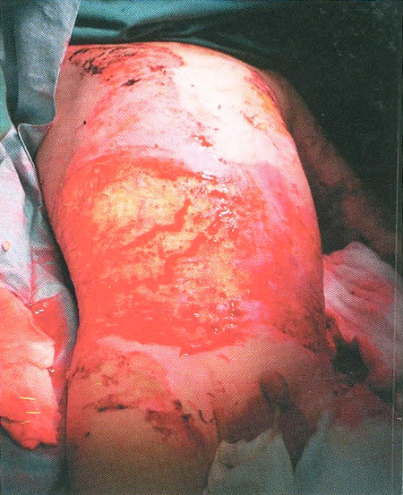 Fig. 2Burned child after excision