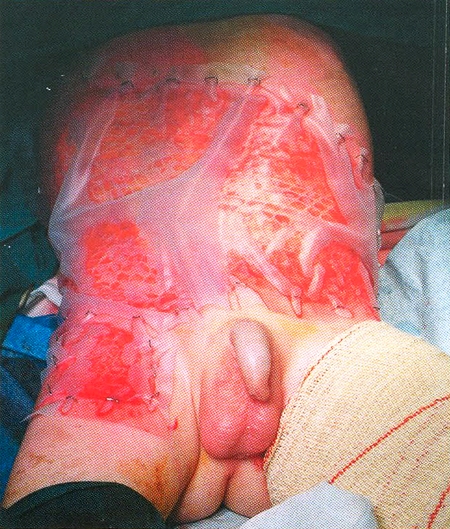 Fig. 4Autografts, meshed 1:3, covering by Surfasoft, stapled to wound margins