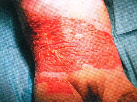 Fig. 5Child with healed autografts