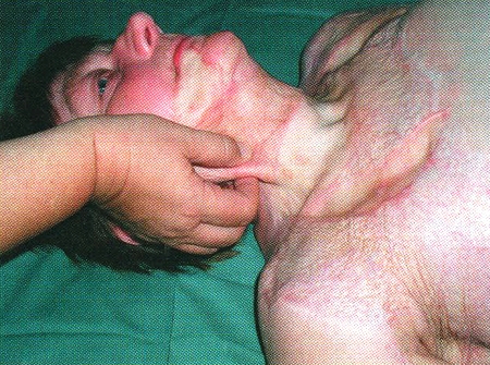 Fig. 6Soft, elastic, non-fixed scar after usinf Integra