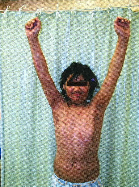 Fig. 7Good function result after reconstruction of scar contracture in axilla