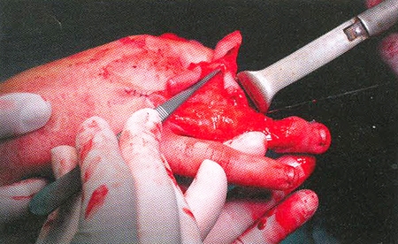 Fig. 1Rotation-advancement flap raised