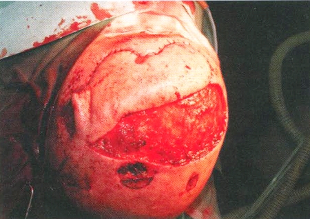 Fig. 3Frontoparietal delay flap transferred into the defect
