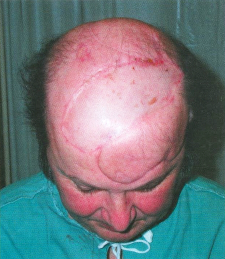 case study electrical burns case study electrical burns