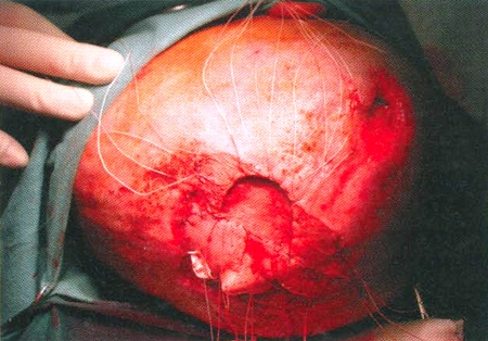 Fig. 5Parietal transposition flap sutured in place