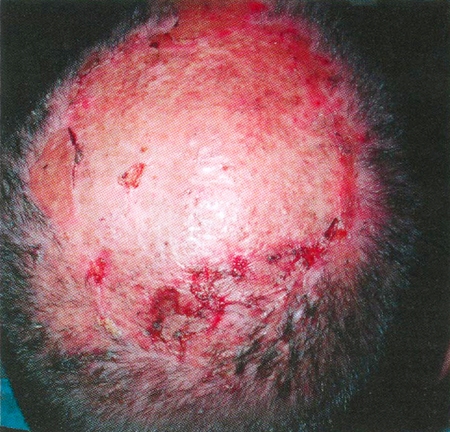 Fig. 6Flaps healed