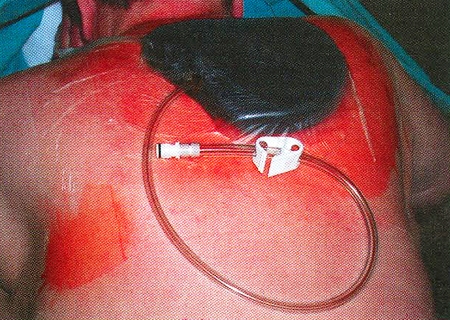 Fig. 2Application of polyurethane sponge and covering membrane