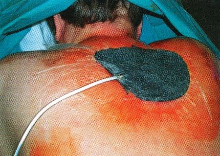 Fig. 3Vacuum suction through the sponge