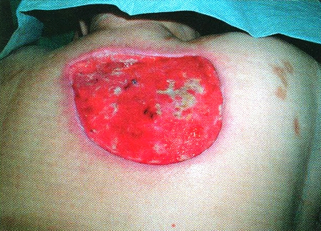 Fig. 4Wound after excision of a carbuncle before VAC®