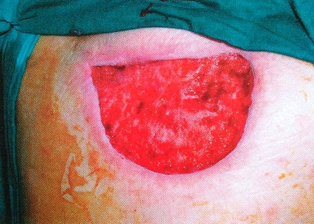 Fig. 5Wound after excision of a carbuncle after VAC®