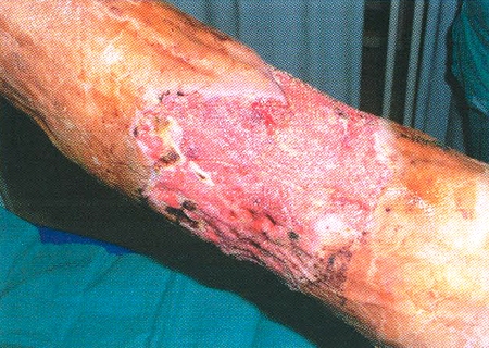 Fig. 6Wound after necrotizing erysipelas before VAC®