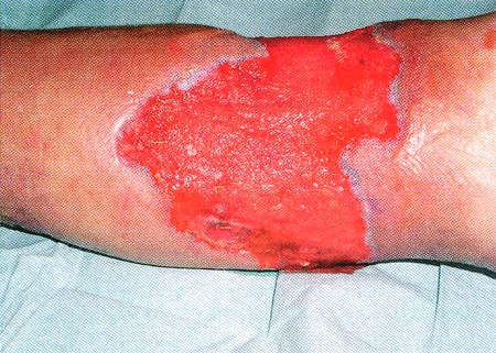 Fig. 7Wound after necrotizing erysipelas after VAC®