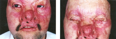 Fig. 1A 30-year-old man suffered third-degree flame burns to the face and chest following a fire accident. Prior skin grafting procedures left him with severe scar deformity of the face
