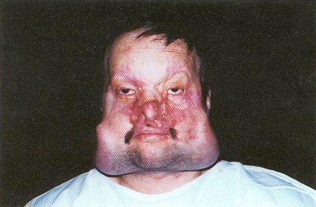 Cellulitis Nose