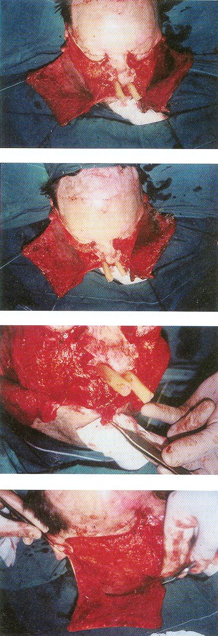 Fig. 3Large, full-thickness skin grats were developed from relatively small donor sites the tissue expanders