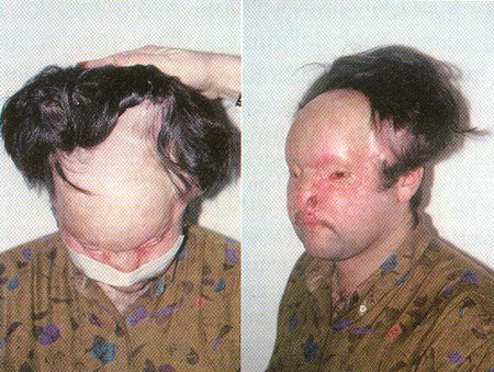 Fig. 4In a second stage, two croissant expanders of 500ml with embodiment injection site were used in the scalp for hair reconstruction