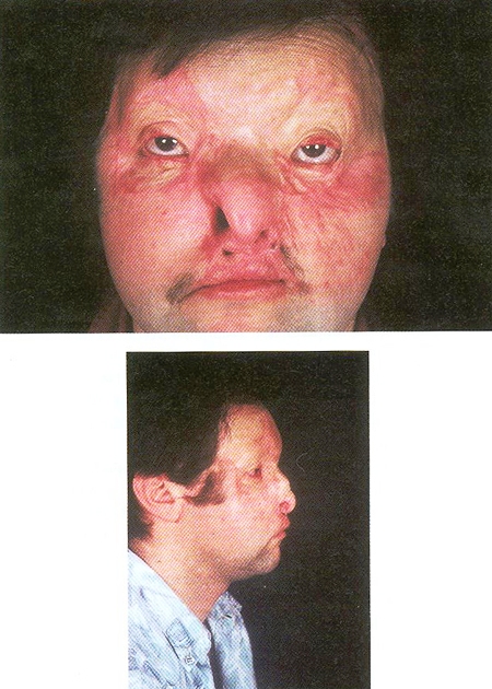 Fig. 5after the second stage an upper lip and nose reconstruction were needed