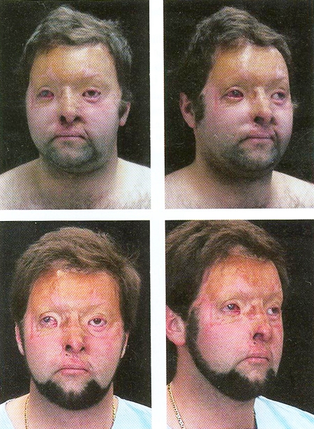 Fig. 6Final result 6 months (above) and one year (down) after the third stage. With cosmetic camouflage, an almost excellent aesthetic result was achieved and the patient is now able to return to his former career