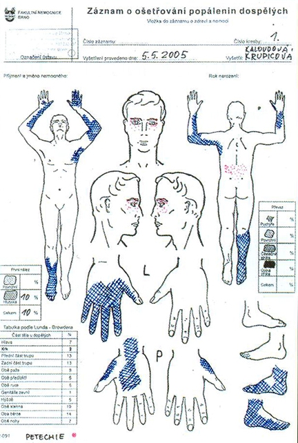 Fig 1Documentation of burn wounds care of the patient