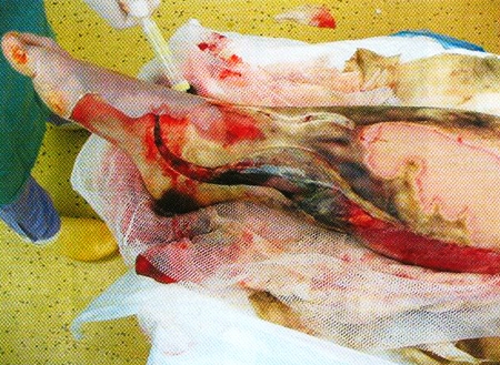Fig 3Right shank sixth day after the injury