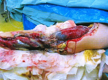Fig 4Left upper extremity eighth day after the injury