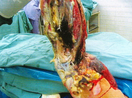 Fig 5Left upper extremity eighth day after the injury