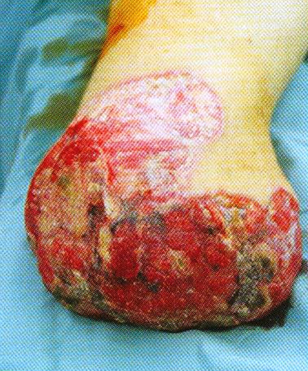 Fig 8Stump of the right shank 18<sup>th</sup> day after the injury