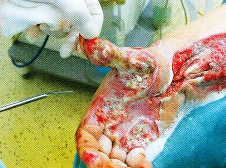 Fig 9Right upper extremity 22<sup>nd</sup> day after the injury