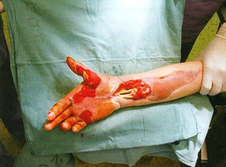 Fig 10Right upper extremity 30<sup>th</sup> day after the injury