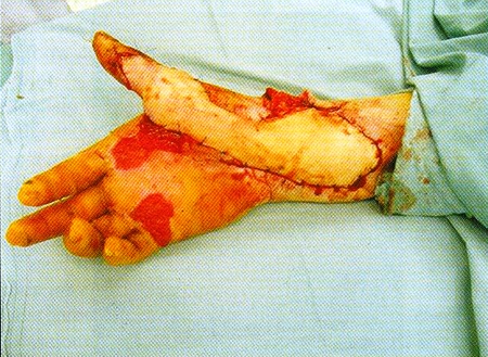 Fig 11Microsurgically transferred parascapular fasciocutaneous flap to the soft tissues defect of right upper extremity