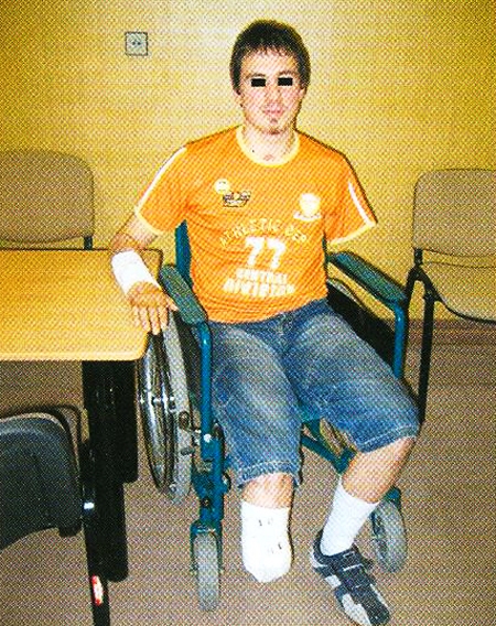 Fig 12The patient 3 months after the high-voltage electric current injury