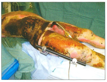 Fig. 3Status afterthe femoral fracture reposition by an external fixator in the burned area