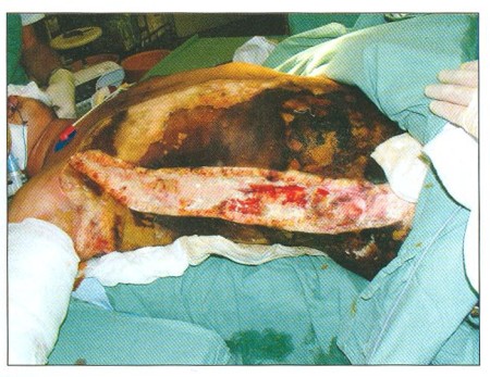 Fig. 4releasing incision on chest