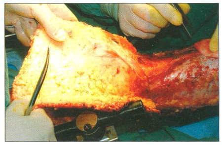 Fig. 5Epifascial necretomy - avulsion on right lower extremity