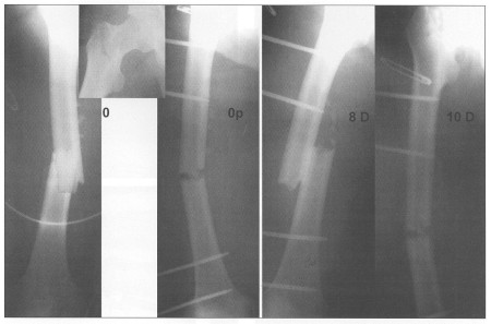 Fig. 6X-ray of the right femur prior to and after insertion of an external fixator