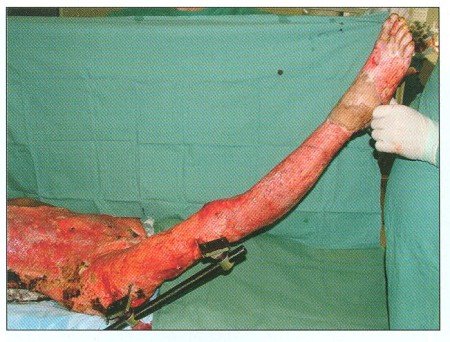 Fig. 7Area of trunk and tight lower extremity prepared fopr autotransplanation (on the right lower crus the first graft already healed)