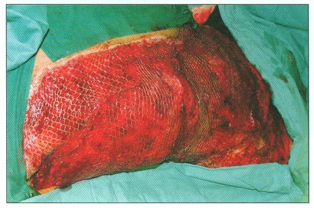 Fig. 8 Freshly meshed grafts within the rate of 1:3 placed on trunk