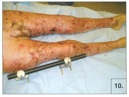 Fig. 10Healed transplanted areas on trunk and right lower extremity, transplanted and harvest areas on the right upper extremity