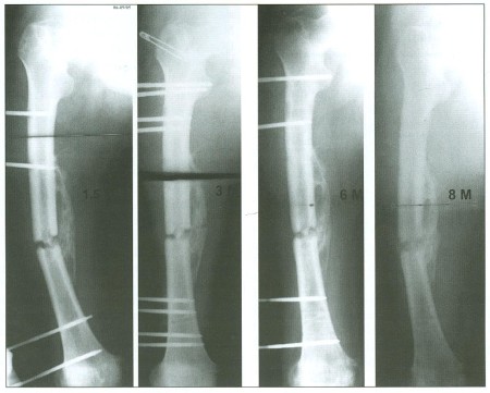 Fig. 11Control X-ray of right femur 1.5, 3, 6 and 8 months after the injury