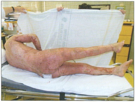 Fig. 12Status at outpatient check-up in April 2007