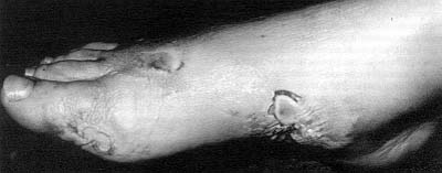 Figure 1 : Cas n° 1. Lésions du pied