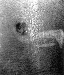 Figure 3 : Cas n° 2. Lésion paraombilicale en regard de la boucle de la ceinture