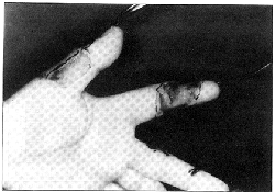 Fig. 4Quemadura el�trica en 1.� y 2.� dedos mano.<br><i>Electric burn of the first and second fingers</i>
