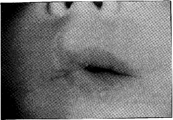 Fig. 6Secuela de quemadura el�ctrica en boca: Microstom�a.