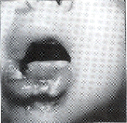 Fig. 9Quemadura el�trica en boca.<br><i>Electric burn of the mouth