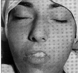 Fig. 1Preoperatorio. Atrofia del hemilabio superior izquierdo que comprende piel en casi todo su espesor, borde rojo en altura. Menor desarrollo del incisivo lateral. El labio inferior abultado puede proporcionar una buena cantidad de mucosa. N�tese que la diferencia de nivel del bermell�n en el labio superior es de 1 cm entre lado izquierdo y derecho. Cresta filtra] izquierda, ausente. Arco de Cupido descendido en su mitad izquierda.<br><b>Fig.1</b> Preoperative view. Upper left hemilabial atrophy comprising the full thickness of the skin. and the vermillion in height. The upper lateral incisor is underdeveloped. The bulky lower lip can supply a good amount of rnucosa. Notice the difference in level of the verntilh�n in the upper hp, which is of I cm between left and right side. The left phtltrutn. vermiflionc utaneous ridge rs absent. The cupids bow is lowered on its left side.