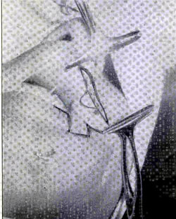 Fig. 2Dibujo de la zona a resecar en el labio superior y de� trazado de] colgajo trifoliado en el labio inferior.<br><b>Fig.2</b> Drawing of the resection zone in the upper lip and tracing of the tri-lobed flap in the lower lip.